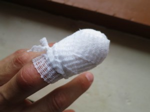 My infected Finger after Treatment