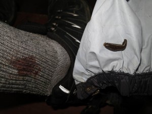 Leech Bite even under the Gaiters